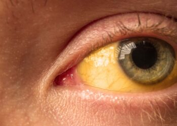 Los casos de hepatitis A se dispararon en Chile y la enfermedad sigue siendo subestimada
